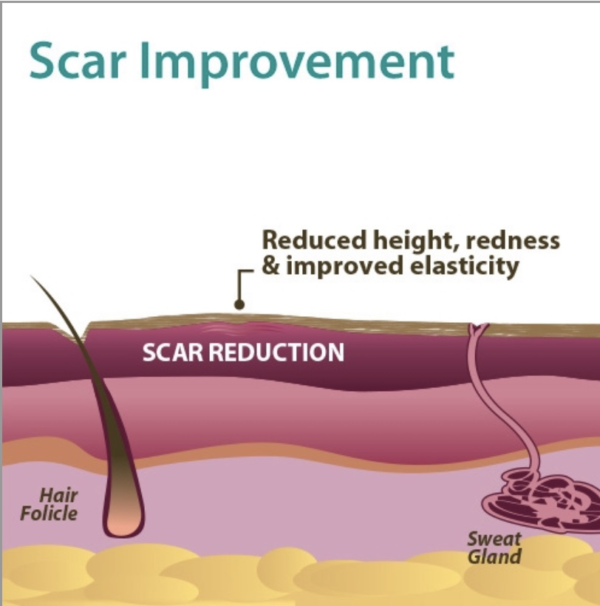 Scar reduction effect diagram